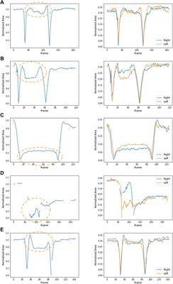 Patient-led development of digital endpoints and the use of computer vision analysis in assessment of motor function in rare diseases